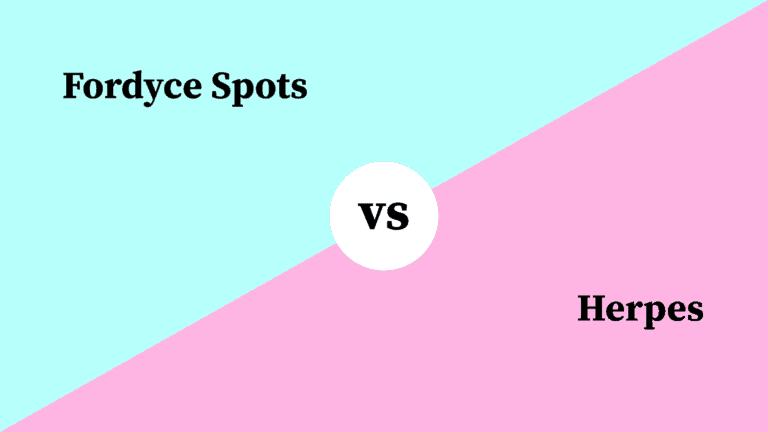 Differences Between Fordyce Spots and Herpes